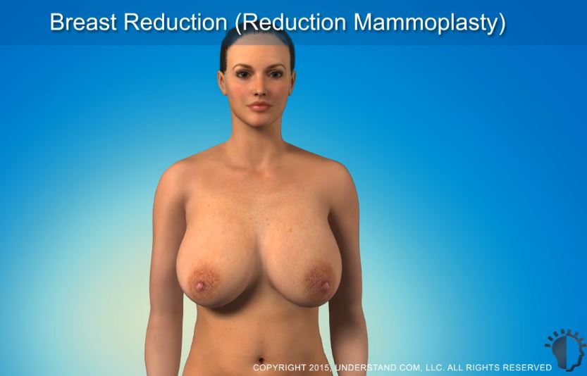 breast reduction
