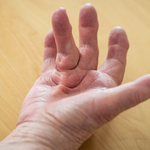 Q&A with Professor Warren Rozen: Dupuytren’s Disease